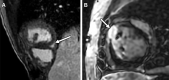 Late gadolinium enhancement (LGE) patterns at MRI in patients with
single ventricle physiology. (A) Short-axis image shows inferior insertion
point LGE (arrow) in a 15-year-old adolescent boy with unbalanced
atrioventricular canal after Fontan operation. (B) Short-axis image shows
LGE (arrow) at the region of ventriculotomy for right
ventricle–to–pulmonary artery conduit (Sano shunt) insertion
along the right ventricular anterior wall in a 13-year-old adolescent girl
with hypoplastic left heart syndrome after Fontan operation.
