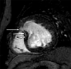 Late gadolinium enhancement (LGE) at MRI in a patient with a systemic
right ventricle. Short-axis image shows superior insertion point LGE with
midmyocardial anteroseptal extension (arrows) in a 27-year-old male patient
with congenitally corrected transposition of the great arteries after
mechanical tricuspid valve replacement.