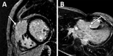 Late gadolinium enhancement (LGE) patterns at MRI in patients with
tetralogy of Fallot (TOF). (A) Short-axis delayed enhancement image shows
LGE in the area of the transannular patch (arrow). (B) Left ventricular
outflow tract delayed enhancement image shows LGE at the ventricular septal
defect patch (arrow) in an 18-year-old woman with history of TOF with
pulmonary atresia after repair.
