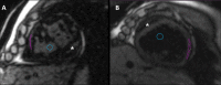 T1 mapping in patients with single ventricle physiology. Native T1
maps from a mid short-axis plane in patients with (A) hypoplastic left heart
syndrome and (B) a hypoplastic right heart. * indicates the
hypoplastic chamber with evidence of hypertrophy and dilatation of the
dominant ventricles. Free wall regions of interest (violet) are drawn on the
free wall of the dominant ventricles, and blood pool regions of interest
(blue) are drawn within the blood pool of the dominant ventricle.