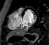 Late gadolinium enhancement at cardiac MRI. Mid short-axis delayed
enhancement image in a 4-year-old boy with bicuspid aortic valve status
after Ross operation and resultant coronary obstruction shows areas of
subendocardial and midmyocardial enhancement in the inferoseptal and
inferior segments, signifying areas of myocardial scarring (arrows). Note
the thin-walled right ventricle obscuring identification of scar.