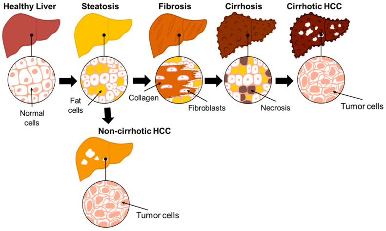 NAFLD and NAFLD Related HCC: Emerging Treatments and Clinical Trials - PMC