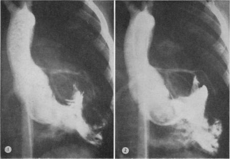 Fig. IV(1)-(2)