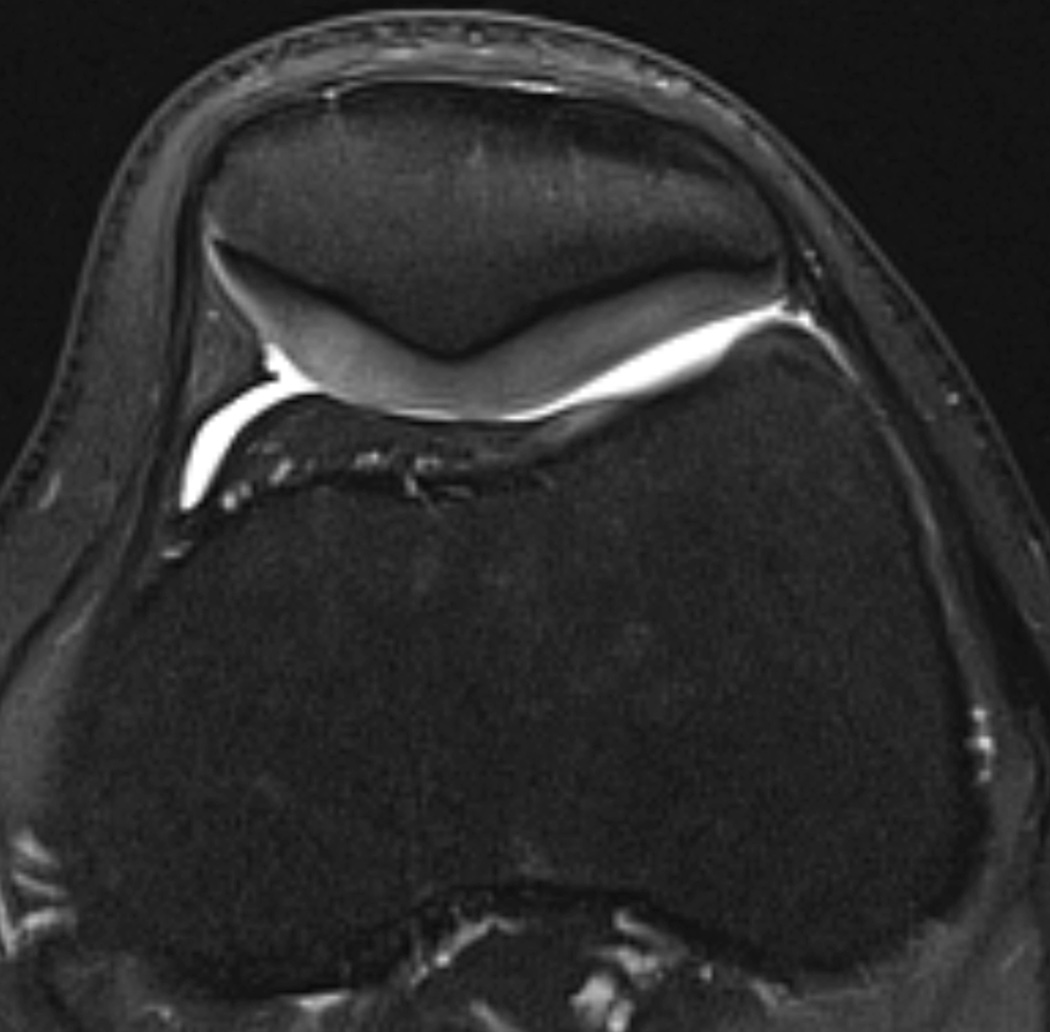 Patellofemoral Friction Syndrome Mri Correlation Of Morphologic And T2 Cartilage Imaging Pmc