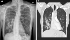 (A) Chest radiograph and (B) corresponding coronal CT pulmonary angiogram
upon admission in a 60-year-old female patient with dyspnea and a history of
right breast cancer treated with partial mastectomy, radiation, and
chemotherapy. Images show nonspecific right lower lobe peripheral
consolidation.