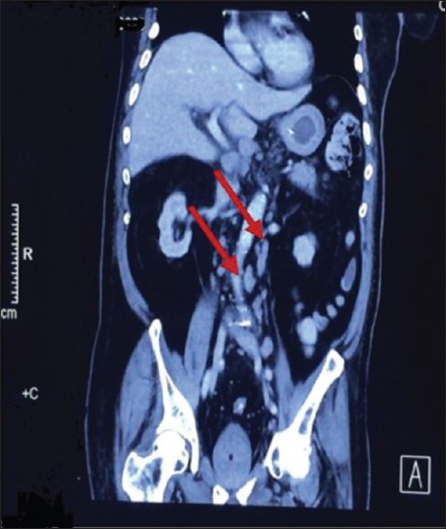 Multifocal cerebral infarction as the first manifestation of occult ...