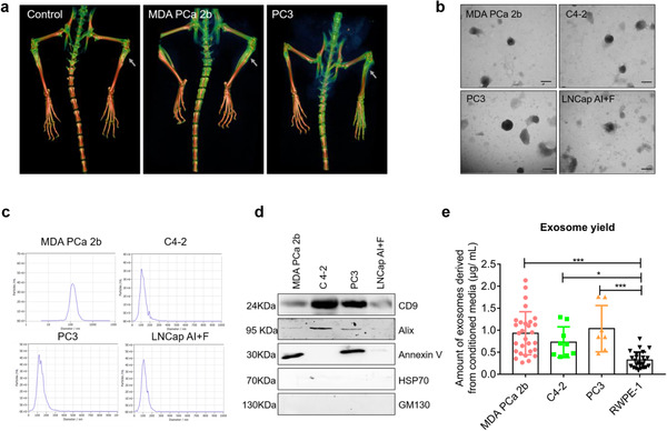 Exosomes derived from osteogenic tumor activate osteoclast ...