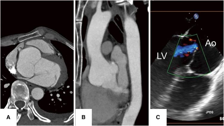 Fig. 1 Findings of preoperative examinations. (A) The axial image of the preoperative CT scan revealed a dilated sinus of Valsalva with a size of 55 mm, which dilated up to 14 mm per 10 years. (B) The sagittal image of CT showed a dilated Valsalva sinus. (C) Echocardiography showed aortic root enlargement and AI. At the end of the diastolic period, a central coaptation defect was observed. AI: aortic valve insufficiency; Ao: aorta; CT: computed tomography; LV: left ventricle