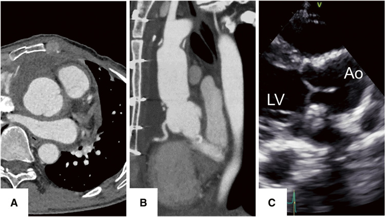 Fig. 3 Findings of postoperative examinations. (A) The axial image of postoperative CT revealed the Valsalva sinus was an excellent form contained without a gap. The Valsalva diameter was reduced from 55 mm to 39 mm. (B) The sagittal image of CT showed no distortion and no stenosis of the bilateral coronary arteries associated with the covered graft. The annulus diameter decreased from 32 mm to 28 mm. (C) The postoperative echocardiography showed that the valve leaflets motion was not restricted and had adequate coaptation without regurgitation. Coaptation height and effective height were measured at 8 mm and 11 mm, respectively. Ao: aorta; CT: computed tomography; LV, left ventricle