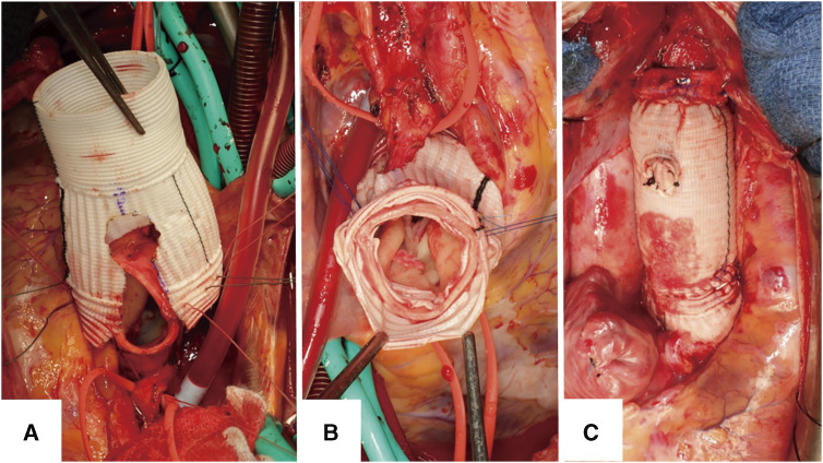 Fig. 2 Operative findings. (A) A “keyhole” was designed for the location of the coronary arteries. (B) The graft sleeve was secured underneath the coronary arteries. To achieve graft positioning below the coronary arteries, a horizontal mattress suture was placed on the base of the “keyhole”. (C) The graft from the ascending aorta and sleeve was sutured. This completes the Florida sleeve procedure.