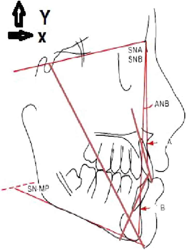 Skeletal Relapse After Mandibular Setback in Bi Max Surgery: Intraoral ...