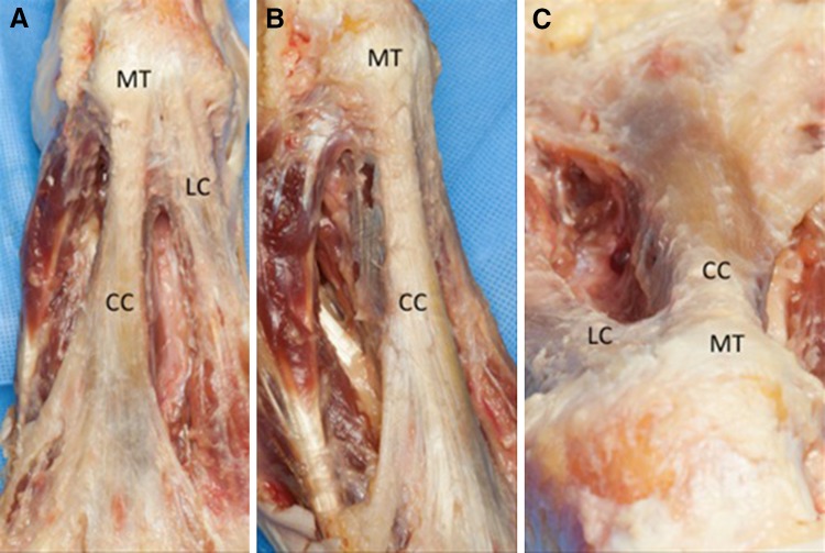 Sonographic Evaluation Of Hindfoot Disorders - Pmc