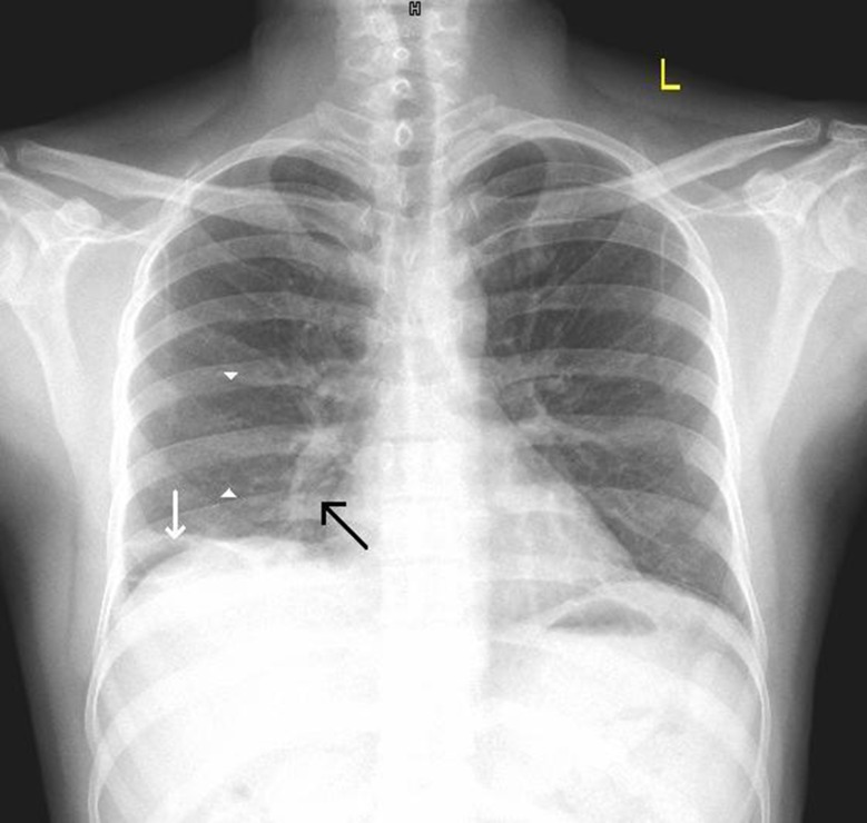 Hampton’s hump, Westermark’s sign and Palla’s sign in acute pulmonary ...