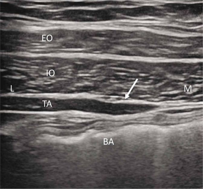 Ultrasound-guided injections in pelvic entrapment neuropathies - PMC