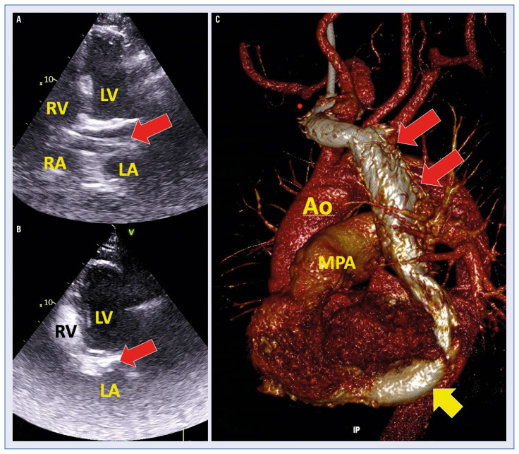 Isolated Persistent Left Superior Vena Cava A Rare And Unexpected Finding In A Patient With