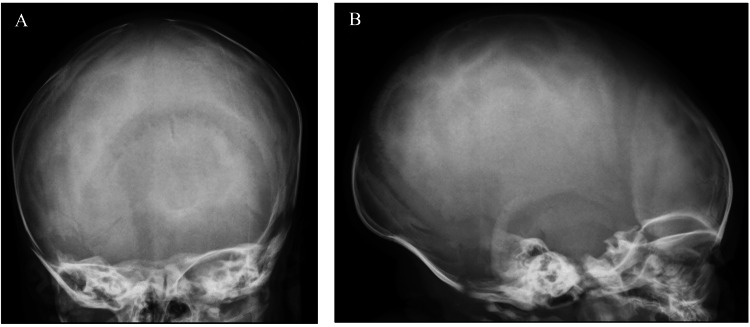 Craniotabes in Newborns and the Role of Maternal Vitamin D Deficiency ...