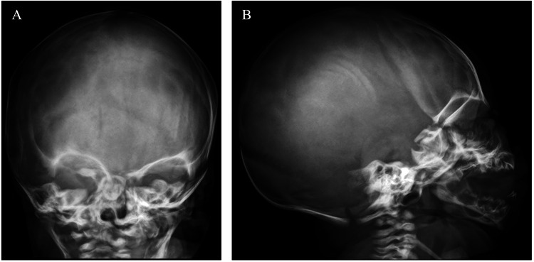 Craniotabes in Newborns and the Role of Maternal Vitamin D Deficiency ...