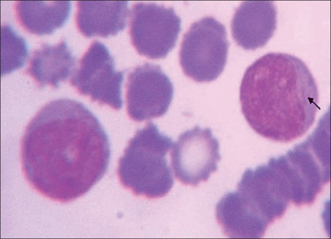 Pancytopenia: A Clinico Hematological Study - PMC