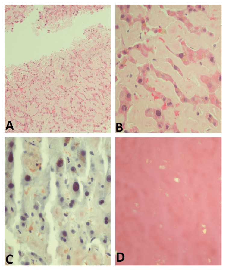 Hepatic Amyloidosis as a Rare Cause of Liver Failure: A Case Report - PMC