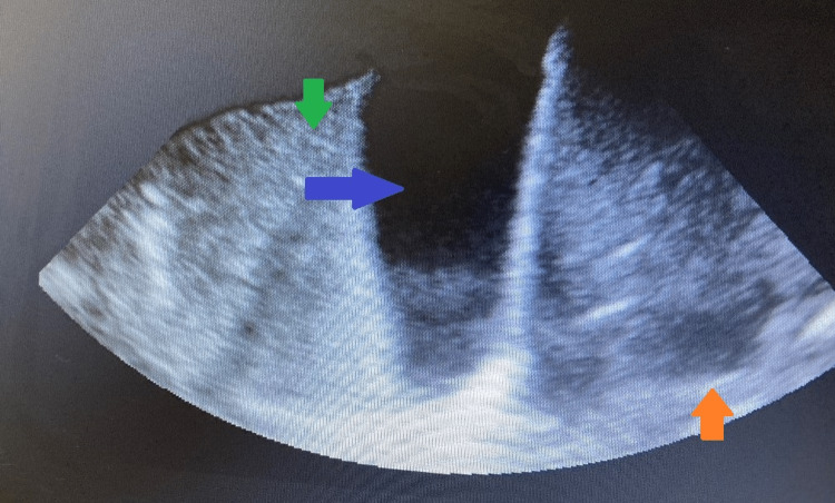 Hepatic Amyloidosis as a Rare Cause of Liver Failure: A Case Report - PMC