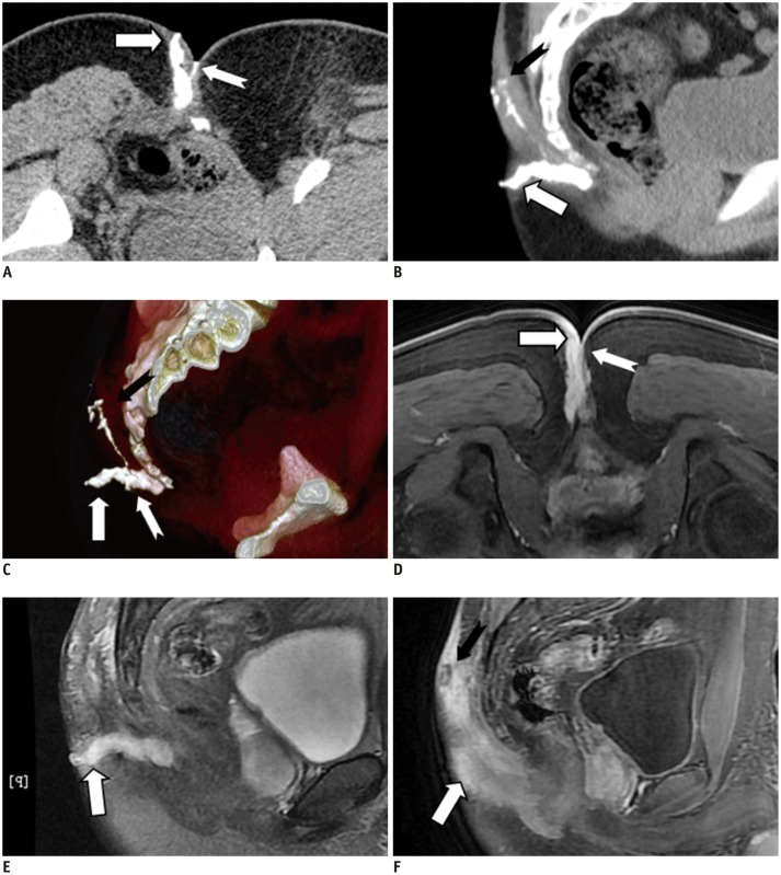 Imaging of Anal Fistulas: Comparison of Computed Tomographic ...