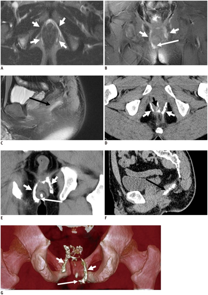 Imaging of Anal Fistulas: Comparison of Computed Tomographic ...