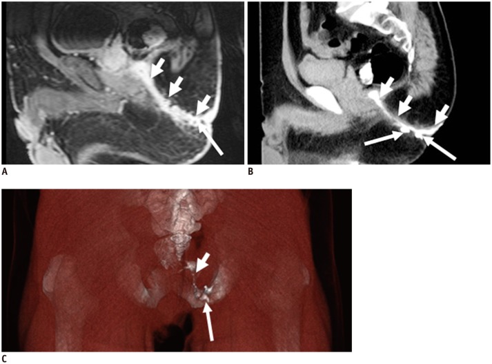 Imaging of Anal Fistulas: Comparison of Computed Tomographic ...