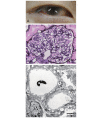 Fig. 3.
Case with LCAT deficiency manifesting as corneal opacities and proteinuria (patient from ref. 31)