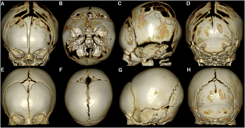 A case of a full-term newborn with severe craniotabes due to ...