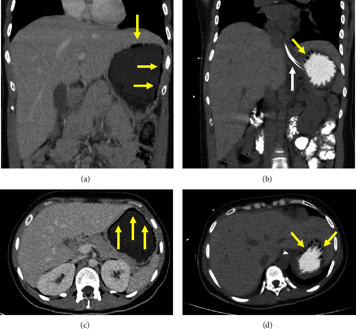 Gastric pneumatosis in the setting of diabetic ketoacidosis pmc