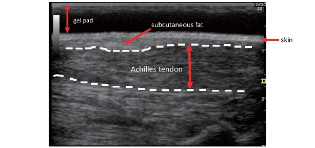 Fig.9. Achilles tendon echo in FH (long-axis cross-sectional image)