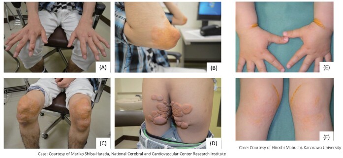 Fig.5. Xanthoma in HoFH