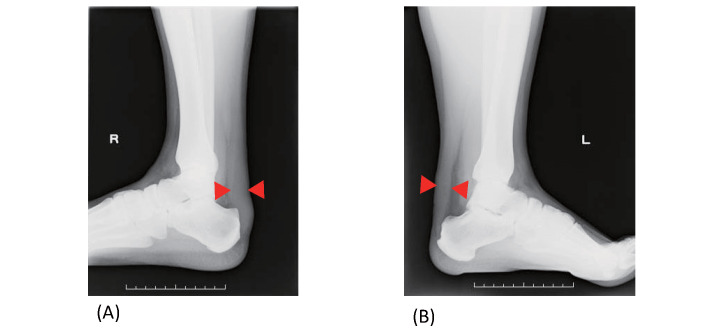 Fig.8. Achilles tendon radiography in patients with FH