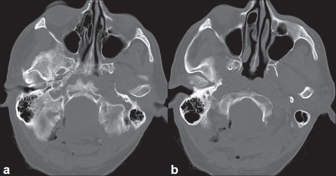 Comparison of dural grafts in Chiari decompression surgery: Review of ...