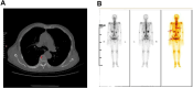 Panel A shows a CT scan of the chest with a cross-sectional view, highlighting a specific area marked in red. Panel B displays three whole-body scans with different imaging techniques, including a color-enhanced image on the right where red arrows indicate specific regions of interest.
