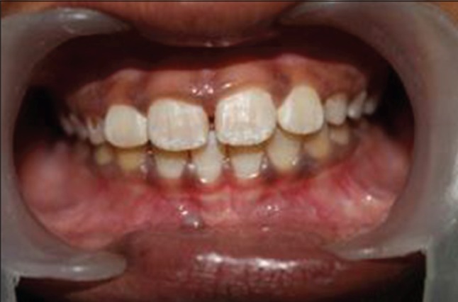 Figure 7a: Clinical image of teeth with distinct grayish
discoloration of primary posterior teeth with normal permanent
anterior teeth.