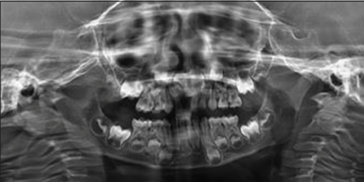 Figure 6c: Orthopantomogram image of teeth with normal
enamel, dentin and bony patterns.