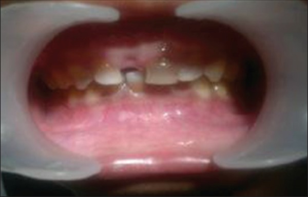 Figure 6a: Clinical image of teeth with distinct grayish
discoloration of primary anterior and posterior teeth.