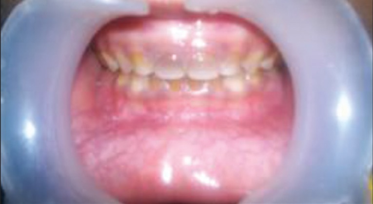 Figure 1a: Clinical image of teeth with distinct grayish
discoloration of primary anterior teeth.