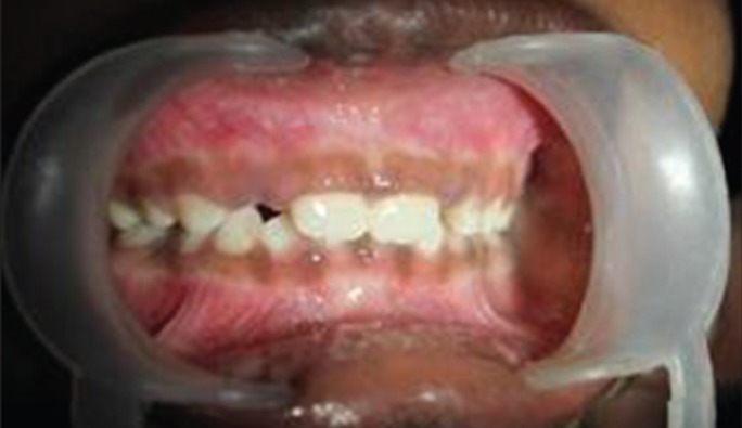 Figure 8a: Clinical image of teeth with distinct grayish
discoloration of primary posterior teeth with normal permanent
anterior teeth.