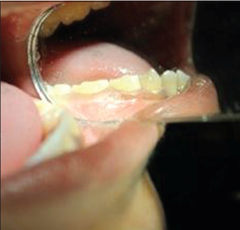 Figure 7c: Clinical image of teeth with distinct grayish
discoloration of primary posterior teeth with normal permanent
anterior teeth.