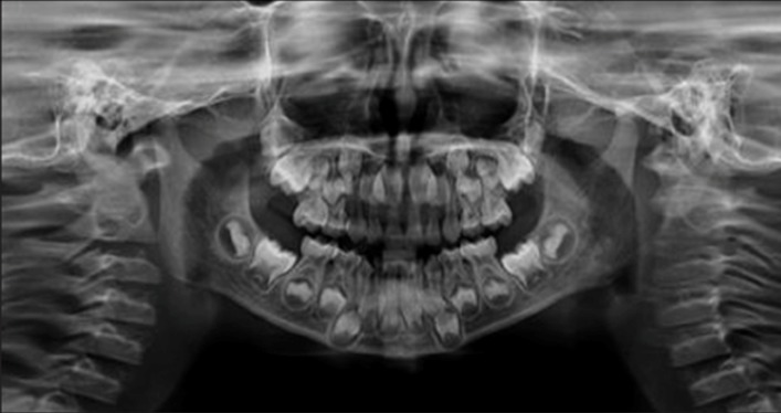 Figure 1b: Orthopantomogram image of teeth with normal
enamel, dentin and bony patterns.