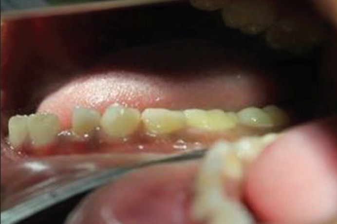 Figure 8c: Clinical image of teeth with distinct grayish
discoloration of primary posterior teeth with normal permanent
anterior teeth.