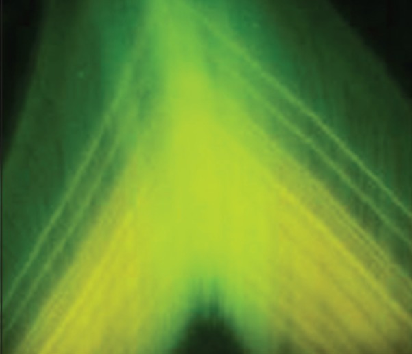 Figure 4a: Ground section tooth under fluorescent microscopy
x10 magnification shows alternative fluorescent bands at the
incisal edge with haziness at the junction.
