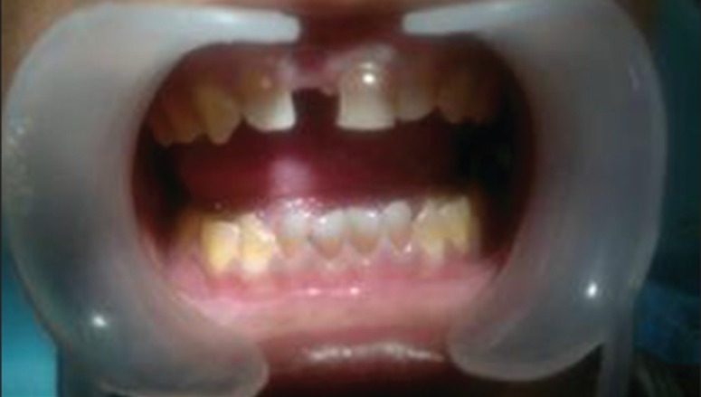 Figure 6b: Clinical image of teeth with distinct grayish
discoloration of primary anterior and posterior teeth.