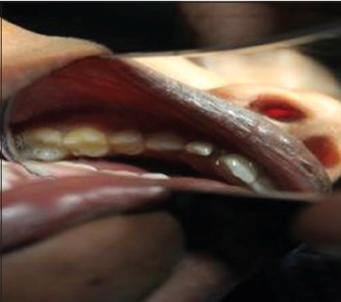 Figure 8b: Clinical image of teeth with distinct grayish
discoloration of primary posterior teeth with normal permanent
anterior teeth.