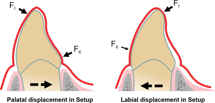 Figure 6. Schematic explanation of the bodily movement capacity of an aligner. This capacity is related to its ability to generate both a countertipping force couple and moment. Its magnitude depends on the smallest contact force component. The tight curvature at the incisal edge reinforces the aligner, leading to relatively high incisal contact forces (Fi) for both displacement directions. In contrast, the cervical contact force (Fc) is higher for palatal tooth displacement (left) than for labial displacement (right). This is due to the specific aligner geometry leading to reinforcement in the cervicopalatal region.