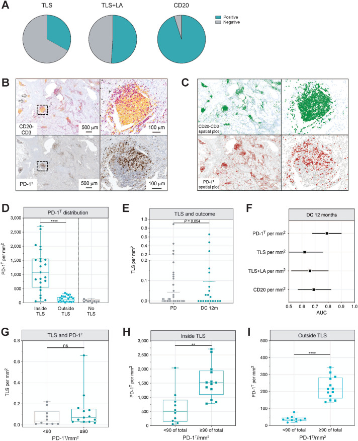 Figure 5. PD-1T high samples contain a higher density of PD-1T TILs inside and outside TLS. A, Percentage of pretreatment samples containing TLS (n = 30), TLS and/or LA (referred as TLS+LA, n = 46) and CD20+ B cells (n = 86) in the remaining cohort (n = 91). B, Top: Example of a CD20-CD3 IHC double staining with the black square showing CD20+ B cells (in yellow) and CD3+ T cells (in purple) localizing in a TLS. Arrows indicate LA. Bottom: Example of a consecutive PD-1 IHC staining with the black square showing PD-1T TILs inside TLS. C, Digital markup showing the spatial distribution of CD20+ B cells (in green) and CD3+ T cells (in light-blue), and digital markup of PD-1T TILs (in red) and all other cells (in gray). D, PD-1T TILs per mm2 inside and outside TLS in resected samples (n = 23), and of total tumor area for resected samples with no TLS (n = 9). Medians, interquartile ranges, and minimum/maximum shown in boxplots (****, P < 0.0001 by Mann–Whitney test). E, TLS per mm2 in pretreatment samples from patients with DC 12 m (n = 20) and PD (n = 71). Shown is the mean, P = 0.054 by Mann–Whitney test. F, The predictive value of PD-1T TILs, TLS, TLS+LA, and CD20+ area per mm2 for DC 12 m (n = 91, note that this cohort is smaller due to the availability of FFPE material). Shown are AUCs with 95% CI interval. G, TLS per mm2 in PD-1T low (<90 per mm2 of total tumor area; n = 10) and PD-1T high (≥90 per mm2 of total tumor area; n = 13) resected samples. Medians, interquartile ranges, and minimum/maximum shown in boxplots (P = 0.18 by Mann–Whitney test). H, PD-1T TILs per mm2 inside TLS and (I) outside TLS in PD-1T low (n = 10) and PD-1T high (n = 13) resected samples. Medians, interquartile ranges, and minimum/maximum shown in boxplots (**, P < 0.01; ****, P < 0.0001 by Mann–Whitney test).