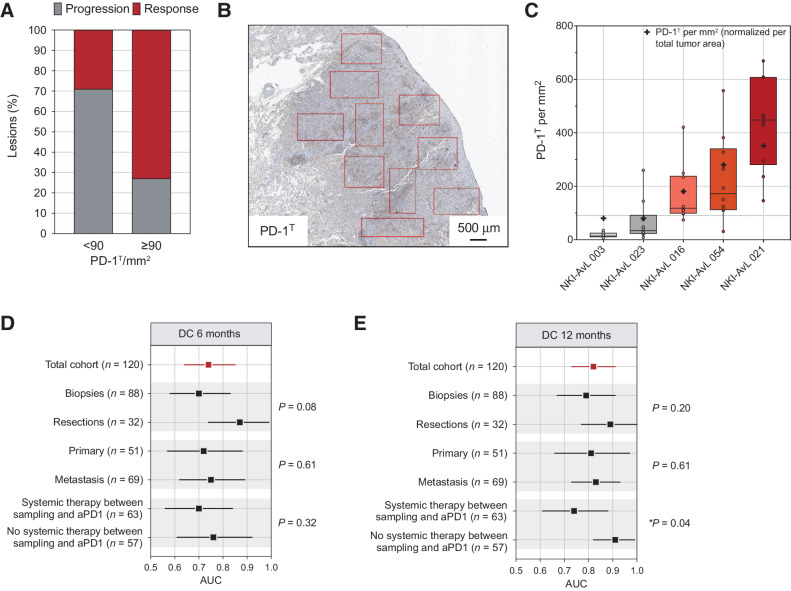 Figure 3. Impact of lesion-specific response and tissue sample properties on the predictive accuracy of PD-1T TILs. A, Percentage of responsive versus progressive lesions during treatment in the PD-1T high (≥90 per mm2; n = 11) and PD-1T low (<90 per mm2; n = 14) group of patients with PD within 12 months. A lesion was defined progressive when ≥20% growth was seen compared with the smallest diameter during treatment. B, Example of a PD-1T high IHC staining with 10 individually annotated tumor areas of 1 mm2. C, Quantification of PD-1T TILs per each mm2 area in five resection specimens. Each dot indicates an individual measurement. Two tumors are PD-1T low (gray shades), three tumors are PD-1T high (red shades). The cross indicates PD-1T TILs per mm2 normalized per total tumor area. D and E, The predictive value of PD-1T TILs in the total cohort and different subgroups. Each comparison is marked in a gray square. Shown is the AUC for DC 6 m (D) and 12 m (E) with 95% CI interval. P value was determined by one-sided permutation test.