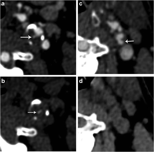 Imaging Of The Ulcerated Carotid Atherosclerotic Plaque A Review Of